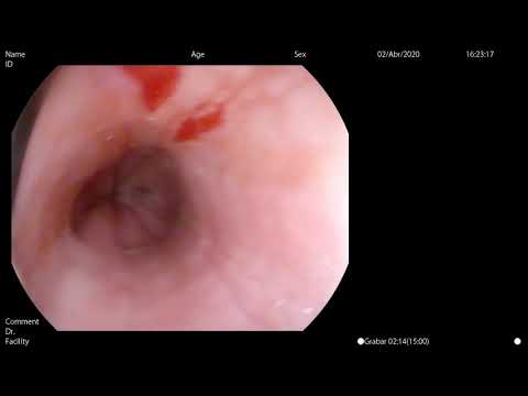 Food bolus impactation