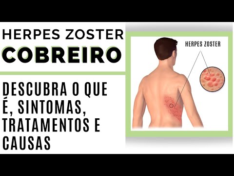 Vídeo: O que escorre das bolhas de hera venenosa?