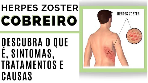 O que é bom passar em cobreiro?