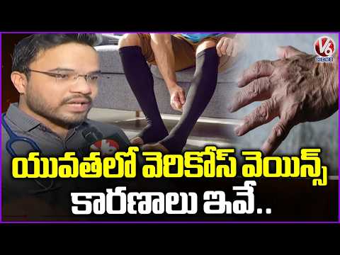 Varicose Veins: Reasons, Symptoms & Best Treatment | Dr. Sandeep Face To Face | V6 News - V6NEWSTELUGU