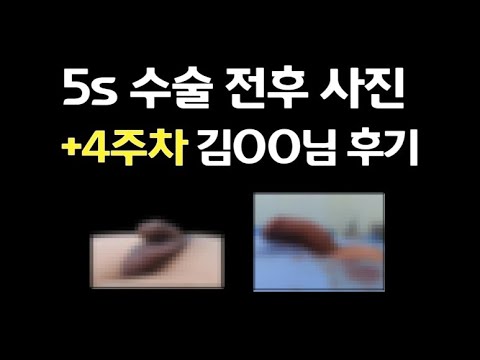 남성확대 수술후기 전후 사진공개 - 4주차 김OO님 - YouTube