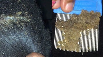 Scalp scratch off // big flakes