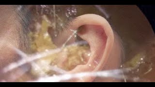 耳掃除の難聴 最大の耳垢除去 | T7H94