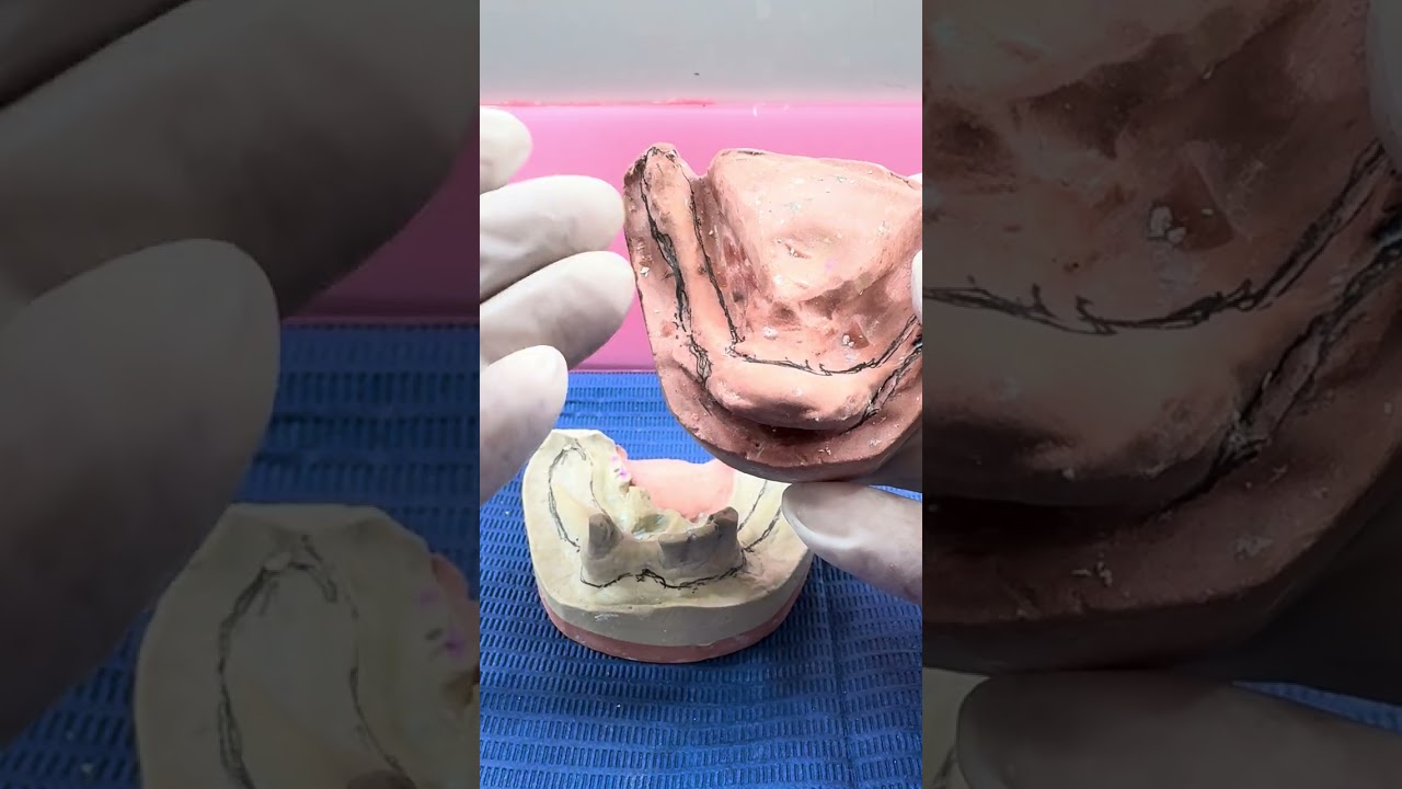 Análisis de modelos para elegir técnica de porta impresión en arcadas inferiores de pacientes reales