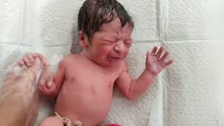 Hairy newborn baby just after birth who is calmed Down by Doctor's touch