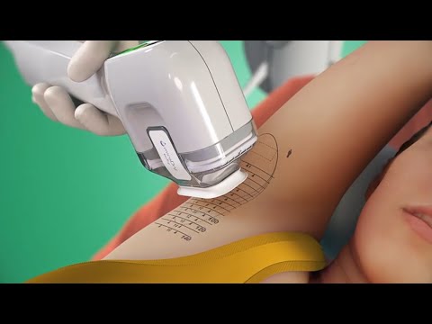 How to treat underarm sweating with miraDry (3D animation)