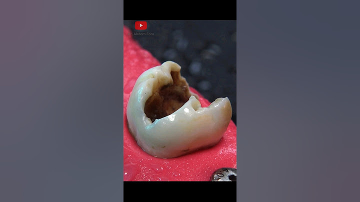 Dental crown procedure #restoration #Shorts