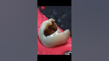 Dental crown procedure #restoration #Shorts