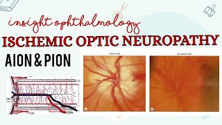 ISCHEMIC OPTIC NEUROPATHY || AION & PION || OPHTHALMOLOGY