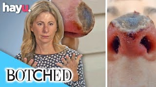 Kelly Removed Her Own Skin Cancer Using Black Salve! | Botched