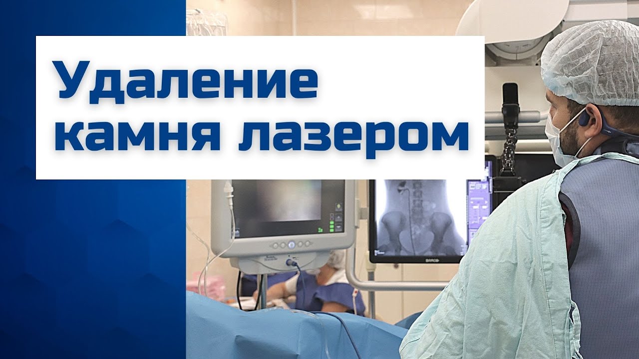 дробление камней в мочеточнике лазером