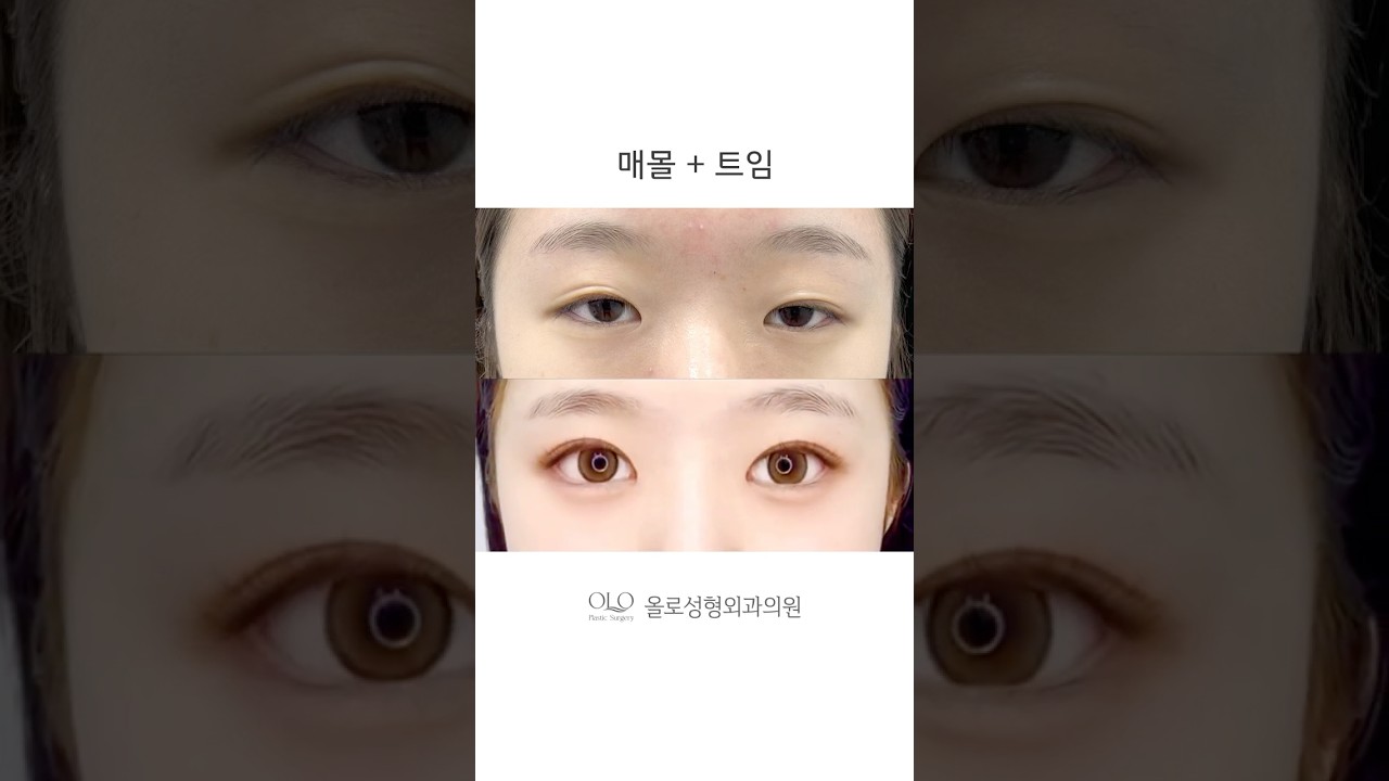 [Олло гоо сайхны мэс заслын эмнэлэг] Миний нүүрэнд тохирсон захиалгат нүдний мэс засал #нүдниймэсзасал #давхарзововхиныхагалгаанысэтгэгдэл