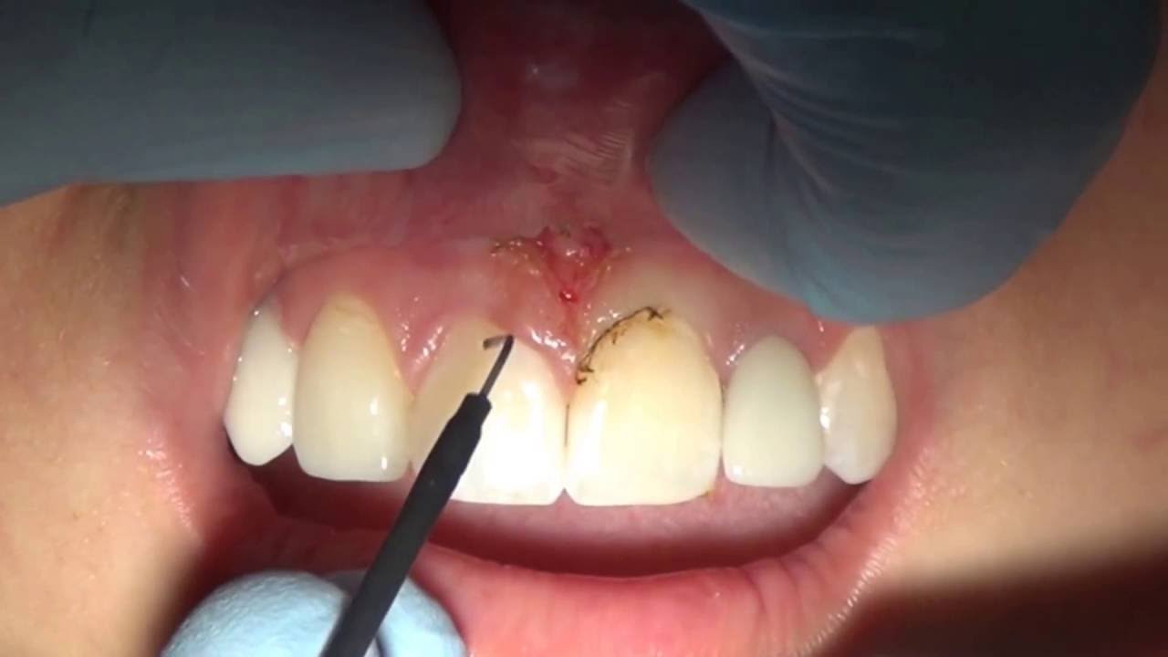 Upper Lip Frenectomy And Gingivectomy Youtube 