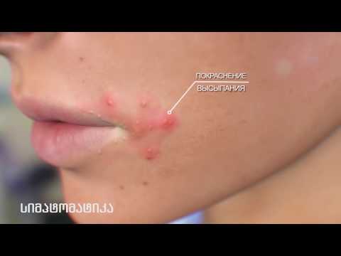 5 საშუალება ჰერპესის სახლში სამკურნალოდ