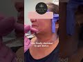 A little Botox never hurt nobody! 😉 #botox #soleiclinic