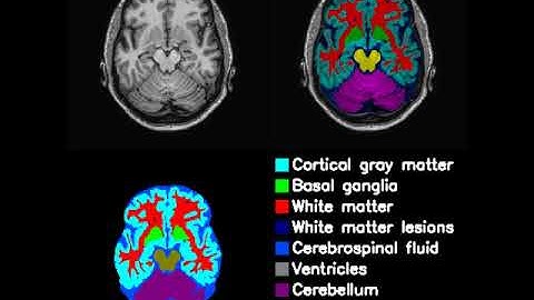 Brain regions segmentation