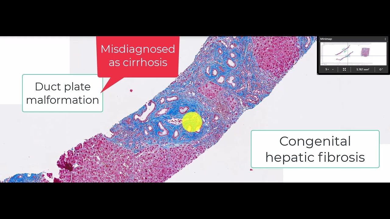 Histology of Congenital hepatic fibrosis - a mimic of cirrhosis - YouTube