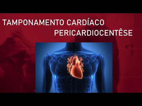 Vídeo: Tamponamento Cardíaco: Causas, Sintomas E Tratamento