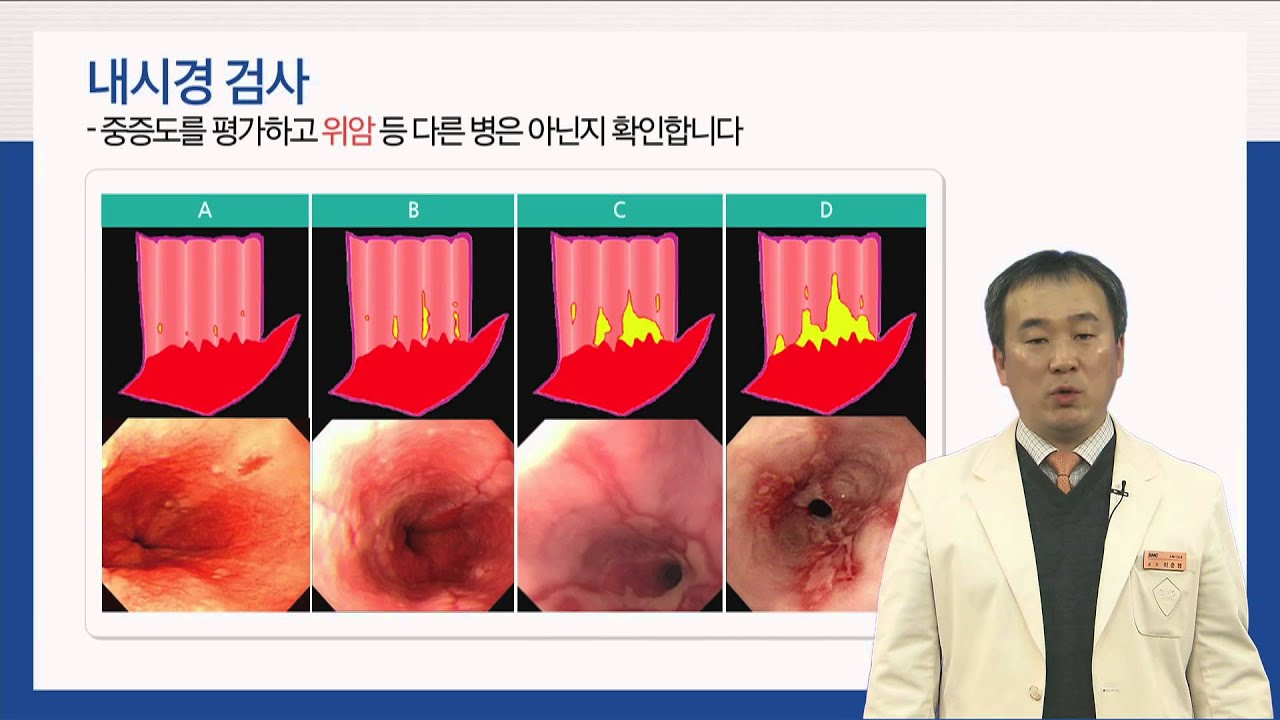 건강산책_위식도 역류 질환 - 소화기내과 이준행 교수[의료진 ON Line 강의]