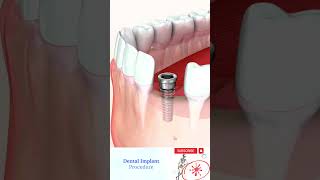 Dental Implant Front Tooth #Shorts