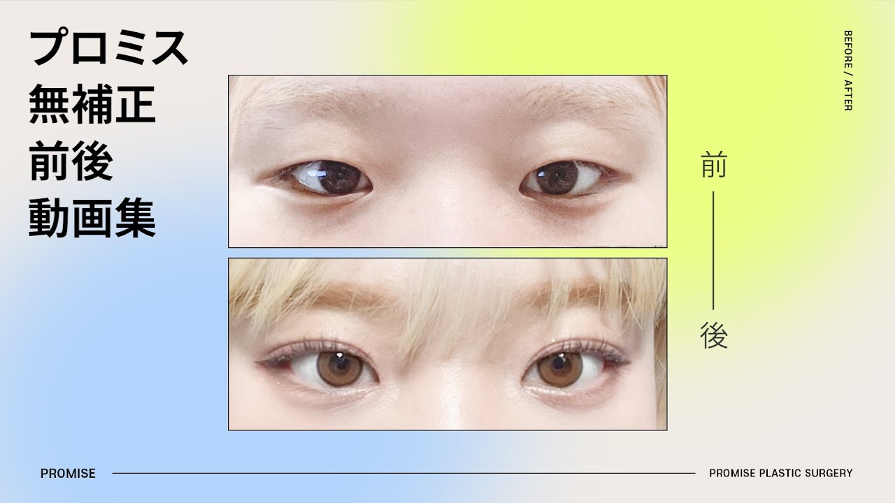 韓国整形外科 プロミス 無補正 手術前後 動画 症例集 💛 比較動画