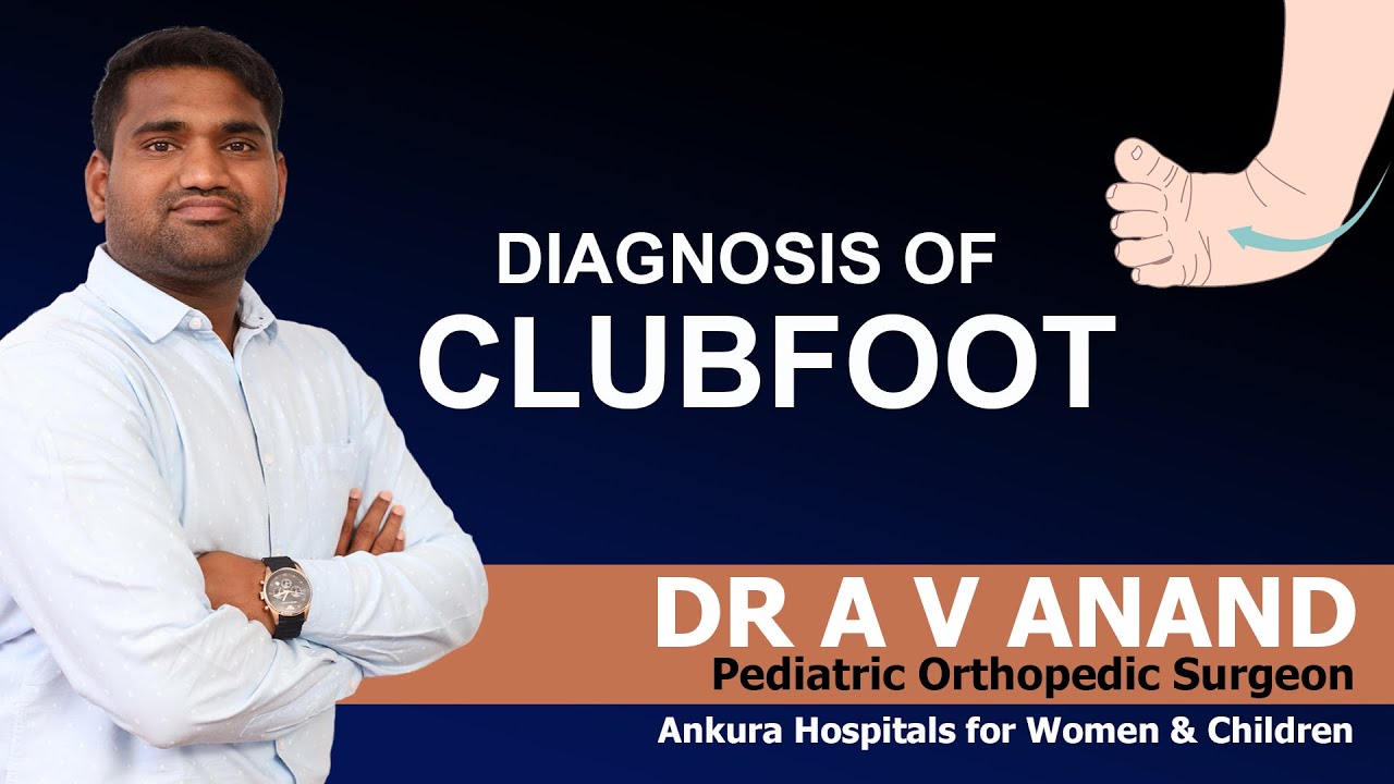Diagnosis of ClubFoot in Children Club foot / Talipes equinovarus