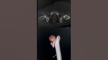 Femur Fracture #femur #femurfracture #radiology #shorts