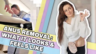 What It Looks & Feels Like to Have Your An*s Removed | Let's Talk IBD