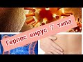 ГЕРПЕС ВИРУС 7 ТИПА ЛЕЧИТСЯ/КИШЕЧНИК/Мой опыт/Без таблеток/