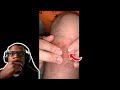 That looks super painful  pimple popping and blackhead compilation reaction