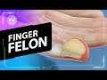 This Fingertip Infection Can Spread to the Bone