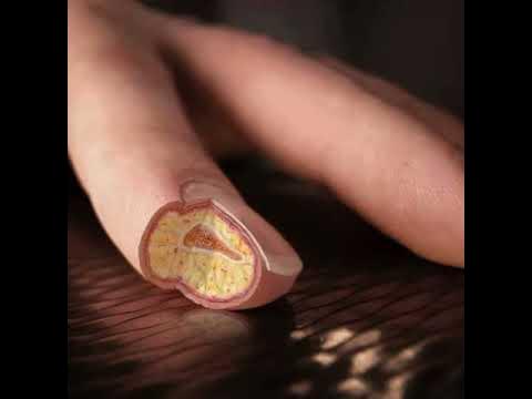 Дикое мясо на пальце руки фото صور لأعضاء الانسان الداخلية سبحان الله - YouTube