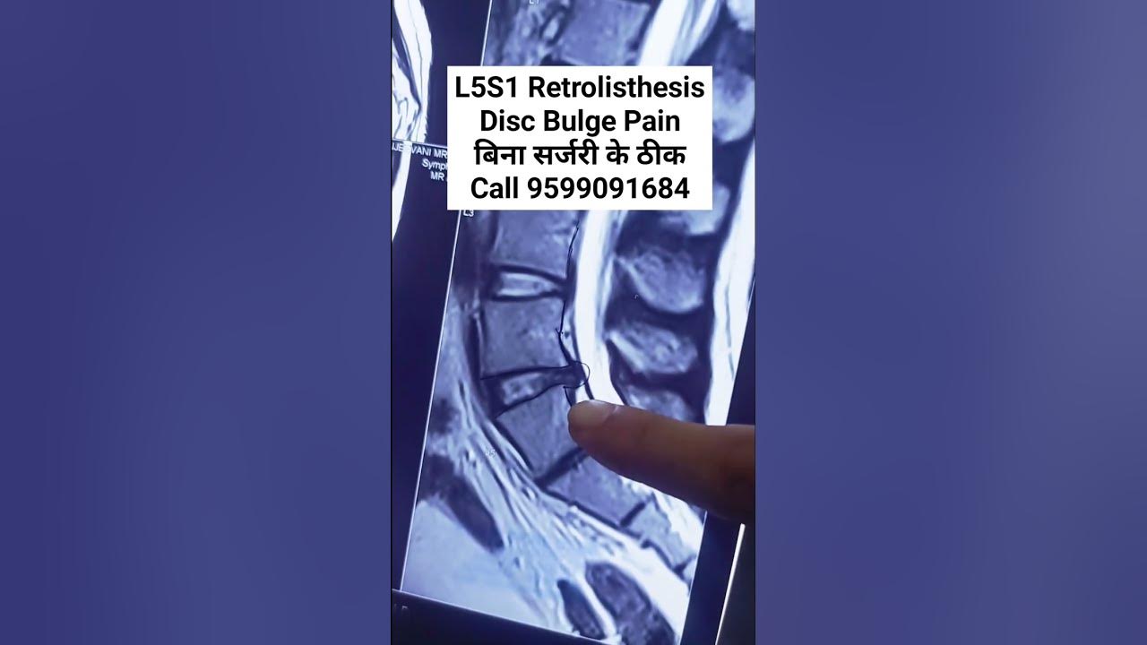 l5s1-retrolisthesis-treatment-back-pain-treatment-chiropractor