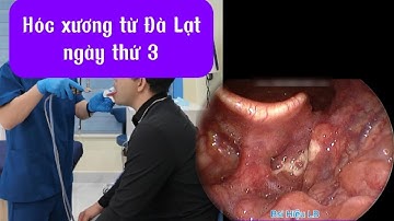 Xương cá từ Đà Lạt 耳かき - ASMR耳掃除 | Bác sĩ Hiệu Long Biên