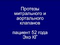 Протезы Митрального и Аортального клапанов. Эхо - Кг.