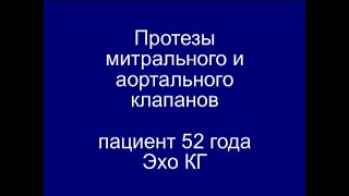 Протезы Митрального И Аортального Клапанов. Эхо - Кг.