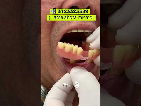 Vídeo: Per què es rellenen les dentadures?