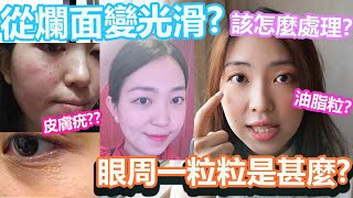 皮膚護理 眼周一粒粒到底是甚麼 是油脂粒 還是皮膚疣 用了這個方法拯救了我的爛面 爛臉康復實錄分享 Cindy Tam我家仙蒂