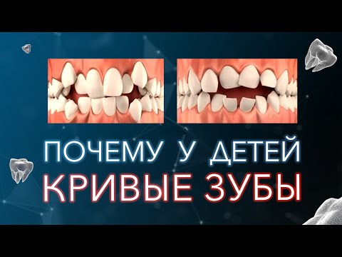 Видео: Почему появляются кривые зубы?