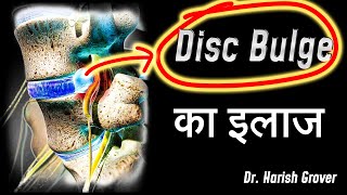 Disc Bulge क इलज जनए सह Chiropractic Technique Dr. Harish Grover