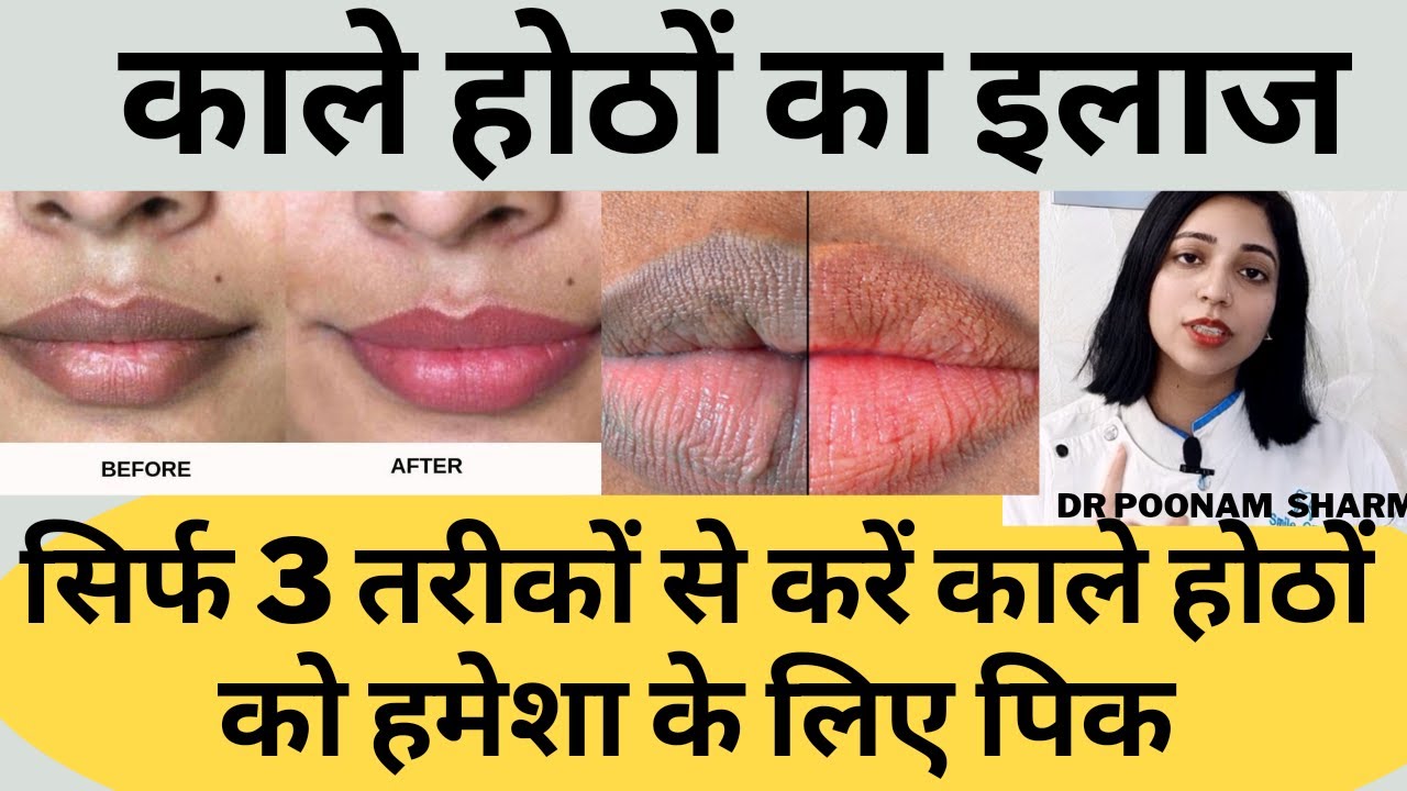 काले होठों का घरेलु इलाज। Dark Lip Treatment At Home How To Get Rid