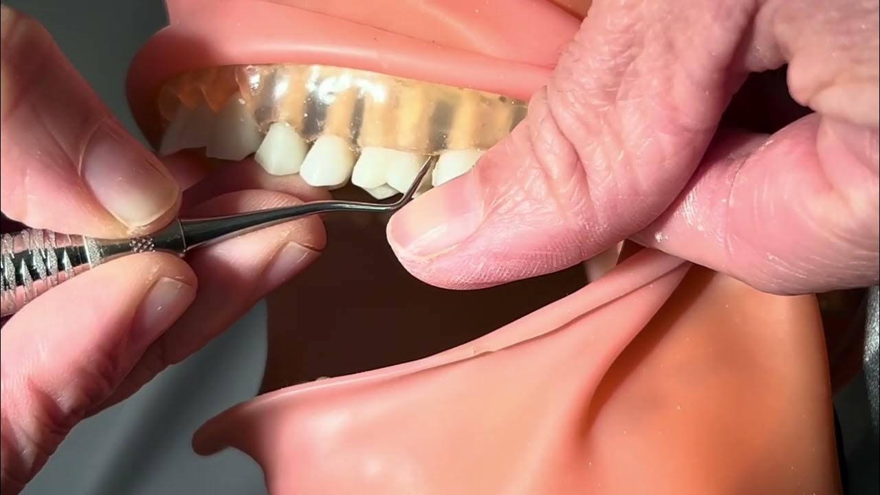 Lab 12 Strokes, Angulation, and Calculus Removal YouTube