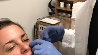 In Office Under Eye Filler Procedure - Dr. Johnson C. Lee, MD