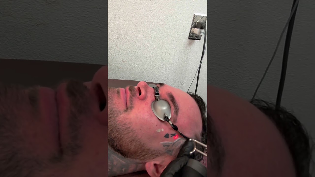 Tattoo Removal 