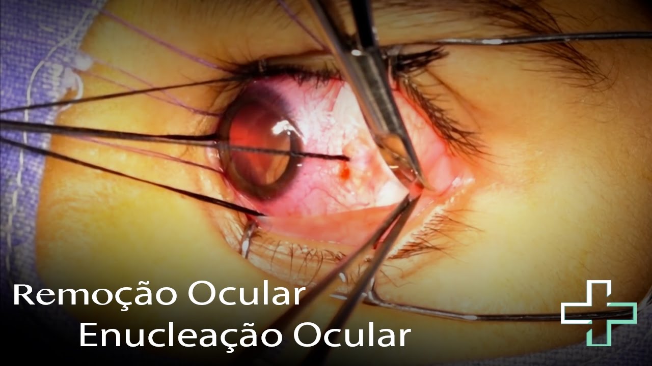 Cirurgia para remoção de olho (Enucleação Ocular) - Medicine Now - YouTube