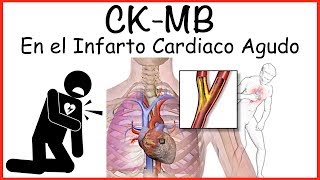 CK MB: Uso en Infarto Cardiaco