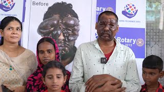 Ravikumar 40 Days After Surgery