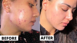 Tretinoin 3 Month Update Faith Restored Tretinoin Before And After Results Dermatica