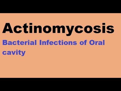 Actinomycosis : Bacterial infections of the oral cavity