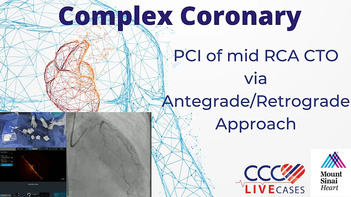 PCI of mid RCA CTO via Antegrade/Retrograde Approach - December 2022
